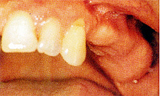 数本の歯を失った場合 インプラント治療前
