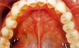 歯のない部分が広い場合 インプラント治療後