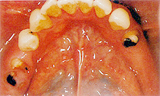 歯のない部分が広い場合 インプラント治療前